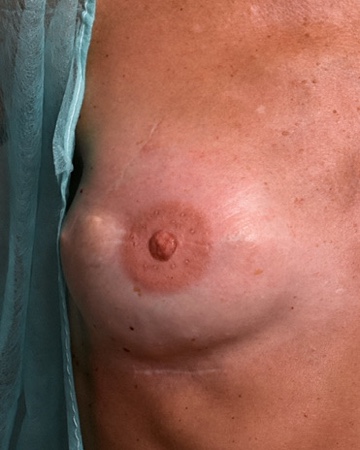 Reparative tattoo: areola and nipple reconstruction