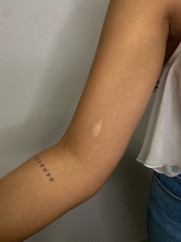 Scar on an arm next to a small fine line script tattoo
